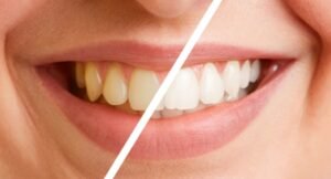 Teeth Whitening Services