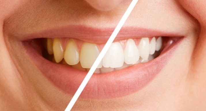 Teeth Whitening Services in Oakville: Safe, Effective, and Tailored to Your Needs